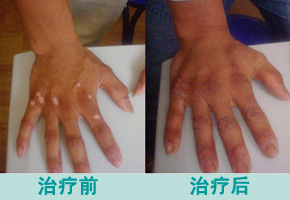 脸上长白斑的原因是什么 