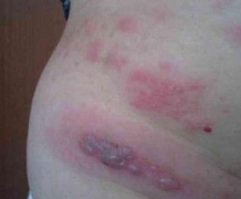 带状疱疹患者生活中需要注意哪些问题呢