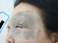 去除太田痣后的注意事项