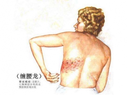 春季预防缠腰龙这样做
