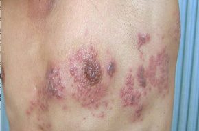 男士腰部带状疱疹很疼怎么办,饮食注意什么