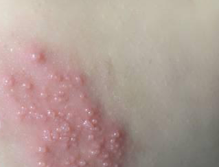 带状疱疹防备的护理办法
