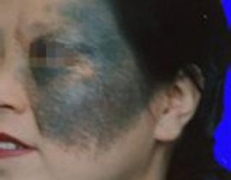 太田痣有哪些症状 危害大吗